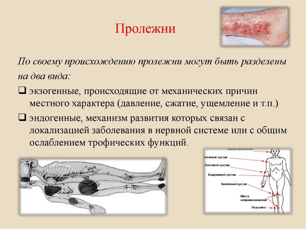 Что такое пролежни Что такое пролежни