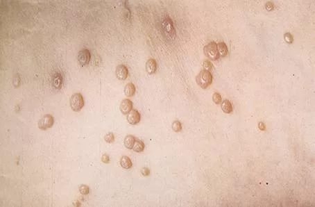 Ожог половых органов у мужчины