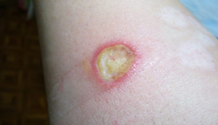 Когда появиться корочка от ожога