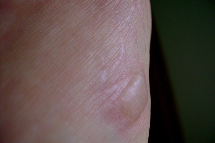 Опасен ли ожог 2 степени