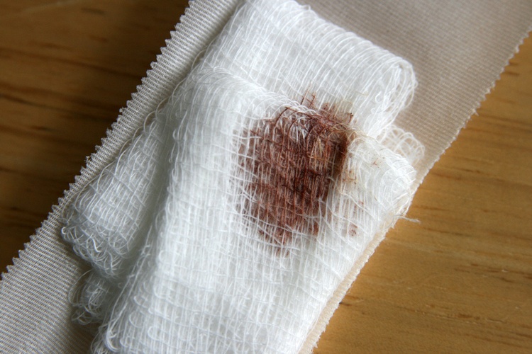 Можно ли волдыри от ожога заклеивать пластырем