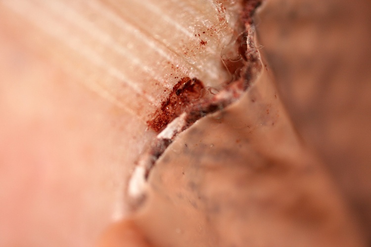 Можно ли волдыри от ожога заклеивать пластырем