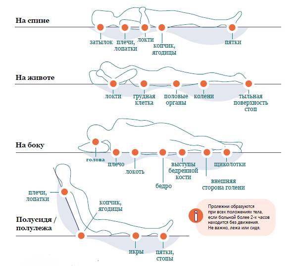 места образования пролежней и позы