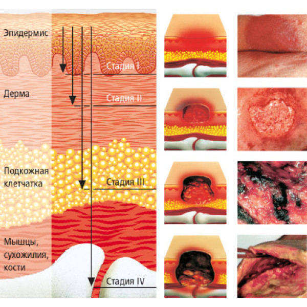 глубина проникновения при разных стадиях пролежней
