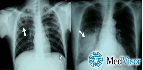 Отличия пневмонии от туберкулеза на рентгене Как дифференцировать пневмонию от туберкулеза