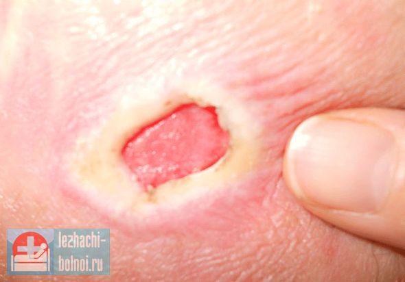 При этом благодаря уходу, кожные покровы остаются целыми, пролежни перед смертью, как характерный признак появляются за несколько дней или недель. Пролежни перед смертью, как характерный признак