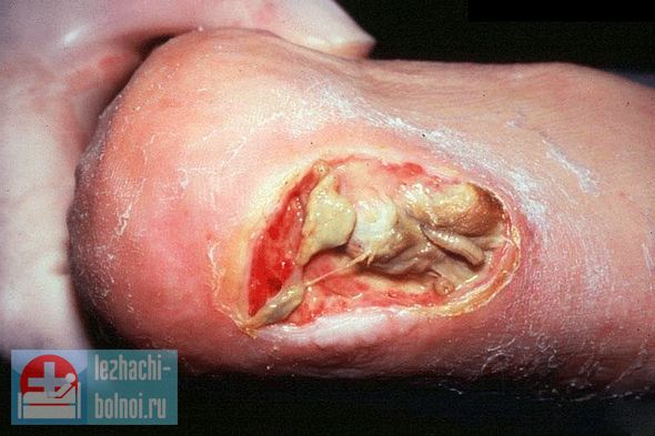 Профилактика не дает никаких результатов, и день за днем область пролежня становится больше. в таком случае врачи говорят, что такие пролежни – признак скорой смерти. Такие пролежни – признак скорой смерти