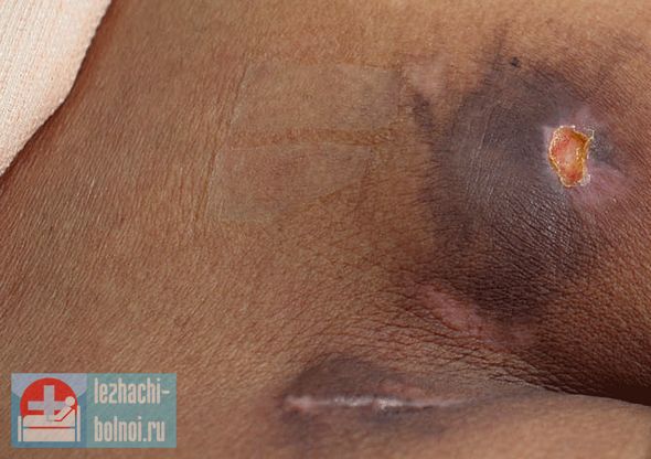 осле развития пролежней у лежачего больного, признаками перед смертью становятся еще более сильные осложнения Развитие пролежней у лежачего больного, как признак перед смертью