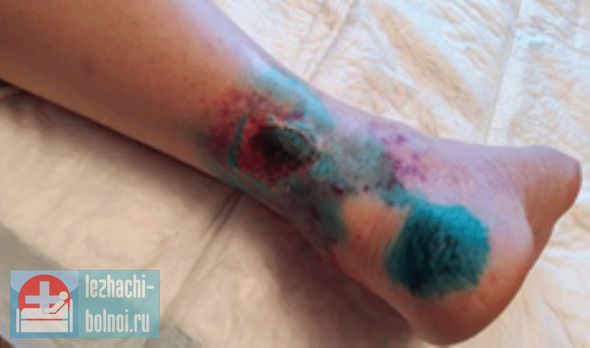 При самой современной помощи, с применением качественных лекарств и средств по уходу – если организм постепенно угасает, ухудшаются и замедляются все процессы, то смерть от пролежней оказывается неизбежной. Осложнение пролежней, сколько осталось жить