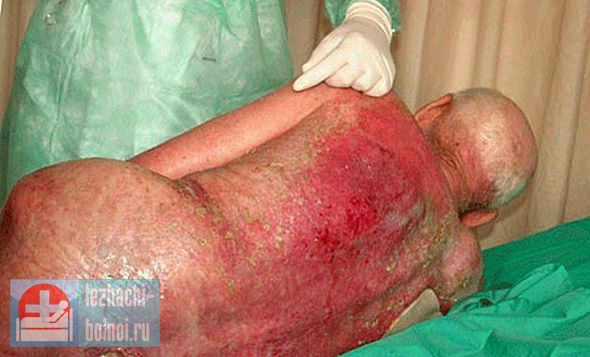 Чем массивней процесс распада, особенно у пожилых, тем меньше продолжительность жизни. Пролежни у старого человека, перед смертью