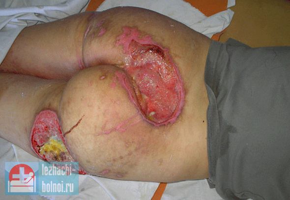 В некоторых случаях вовлекаются родственники, поскольку считают, что больной знает лучше и правильно оценивает свое состояние. Сколько до смерти, если появились такие пролежни