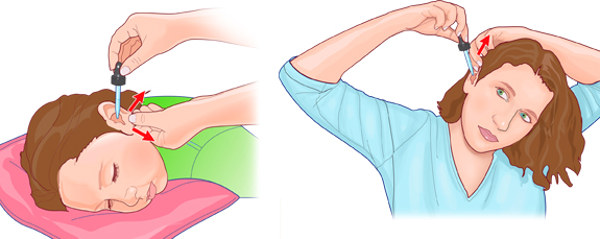 Чем закапывать уши при отите