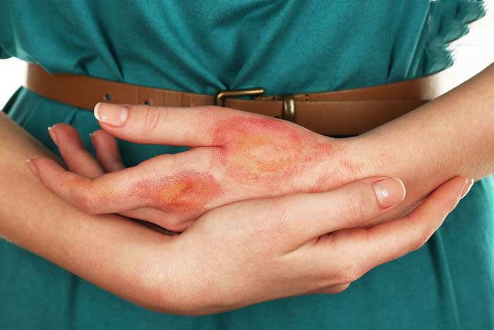 ожог приметы