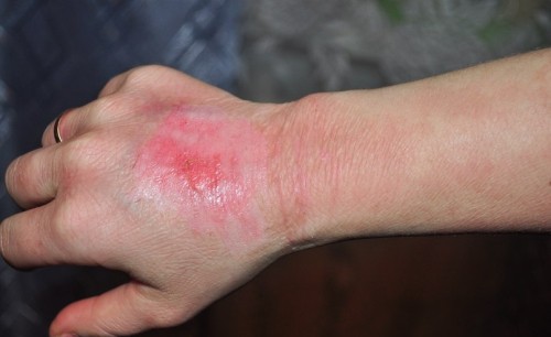 ожог 1 степени ожог 1 степени