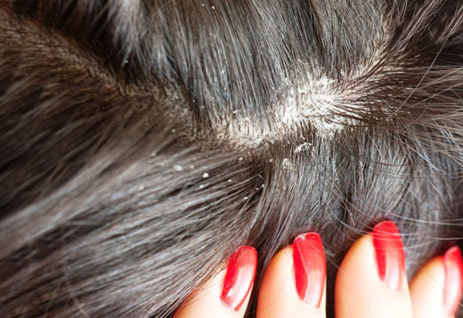 Перхоть и шелушение кожи