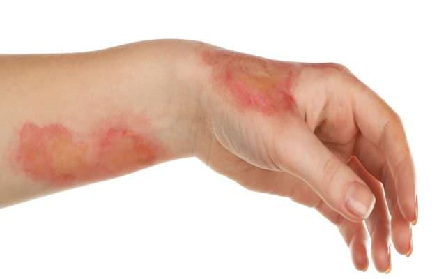 Когда появиться корочка от ожога