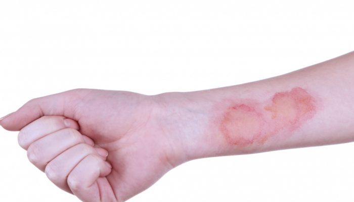 Когда появиться корочка от ожога