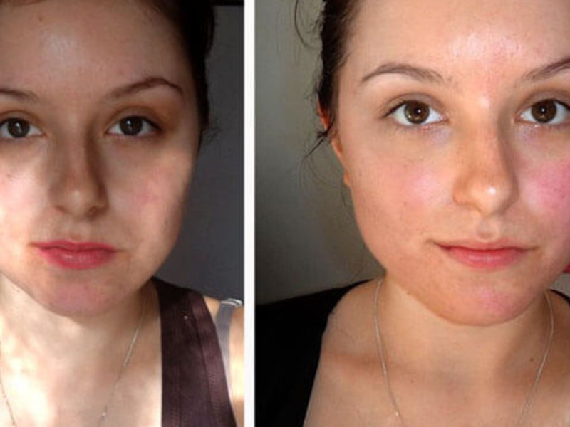 Как проводить ретиноевый пилинг для лица в домашних условиях