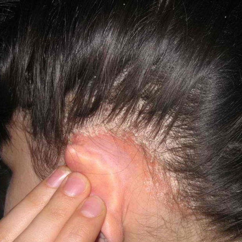 Дерматит у детей - основные причины, симптомы, диагностика и варианты лечения. Видео + 120 фото проявлений детского дерматита