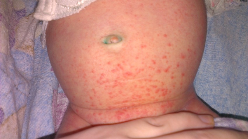 Аллергическая сыпь у детей: как выглядит и почему появляется сыпь у детей разных возрастов. Лечение и профилактика аллергии у детей (140 фото)