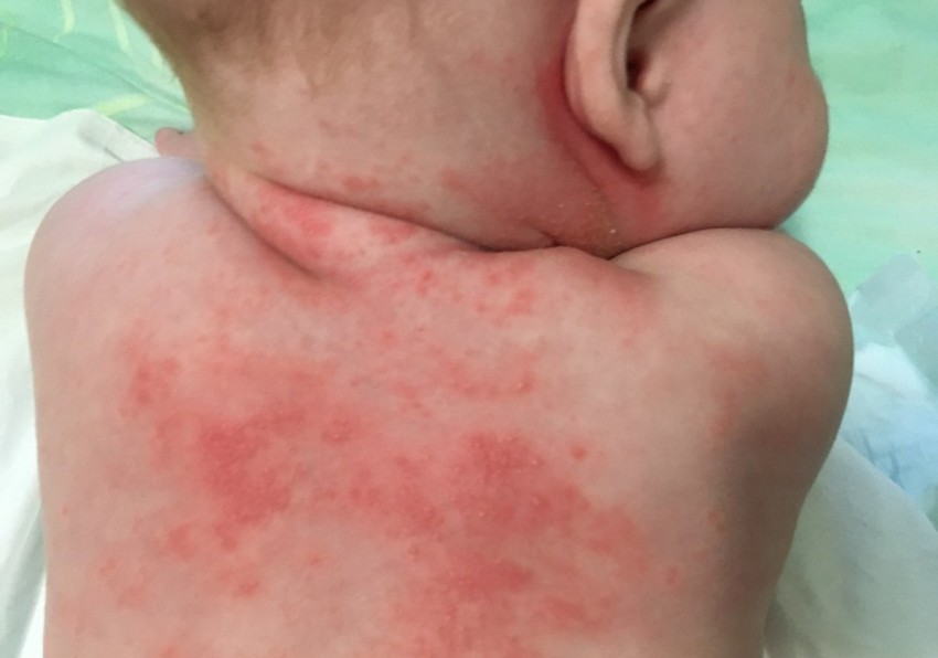 Аллергическая сыпь у детей: как выглядит и почему появляется сыпь у детей разных возрастов. Лечение и профилактика аллергии у детей (140 фото)