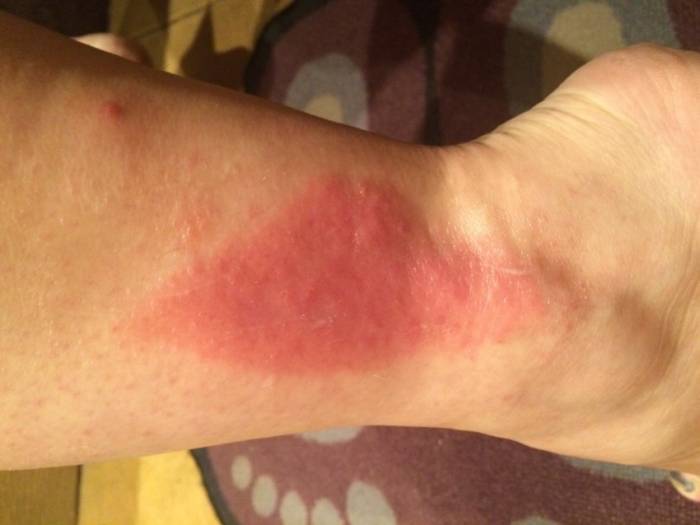 Аллергическая сыпь у взрослых: 110 фото проявлений, симптомы, определение аллергена и советы по выбору лекарства