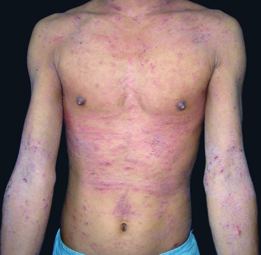 Аллергическая сыпь у взрослых: 110 фото проявлений, симптомы, определение аллергена и советы по выбору лекарства