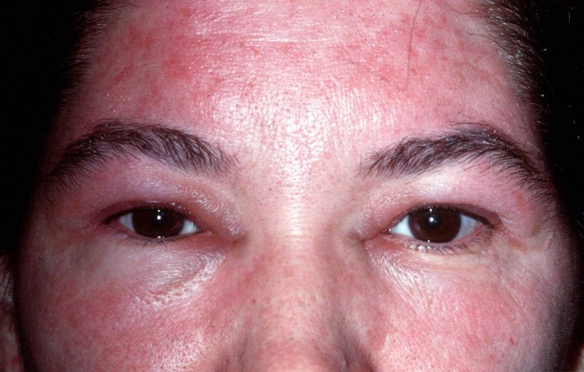 Аллергический дерматит - причины появления, первые симптомы и лечение у детей и взрослых (видео + 130 фото)