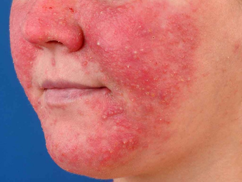 Аллергический дерматит - причины появления, первые симптомы и лечение у детей и взрослых (видео + 130 фото)