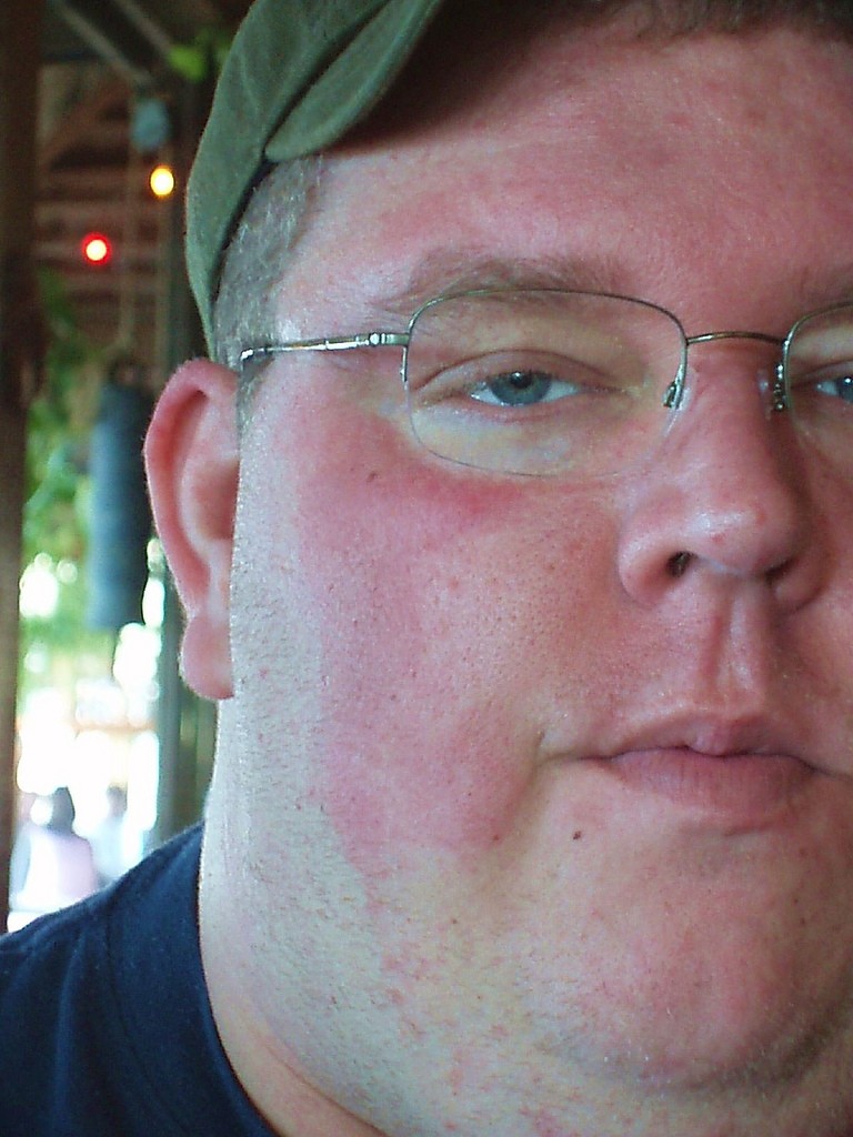 Аллергия на лице - виды, проявления, диагностика, развитие аллергической реакции, методы ее купирования и поиск причины (115 фото)