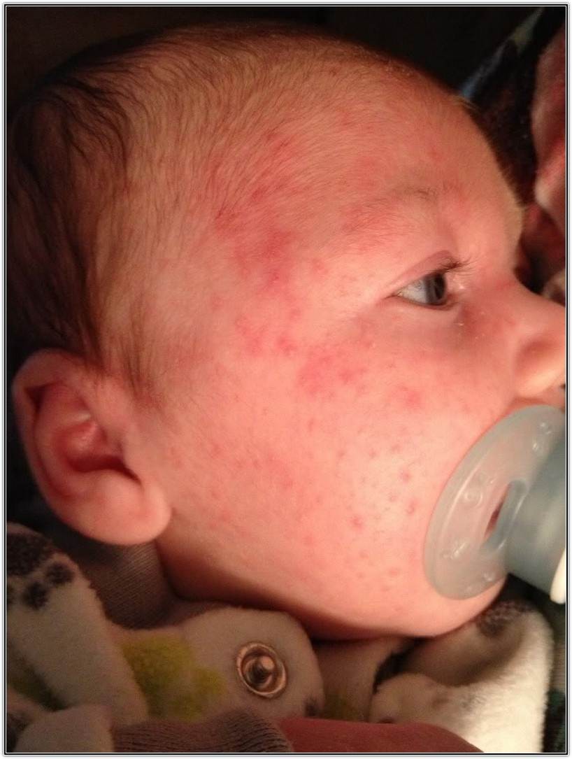 Аллергия на лице - виды, проявления, диагностика, развитие аллергической реакции, методы ее купирования и поиск причины (115 фото)