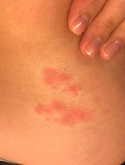 Атопический дерматит - как лечится заболевание кожи и к какому врачу следует обращаться с проблемой (100 фото)