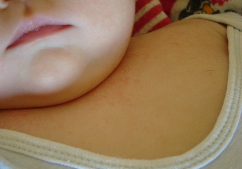 Атопический дерматит - как лечится заболевание кожи и к какому врачу следует обращаться с проблемой (100 фото)