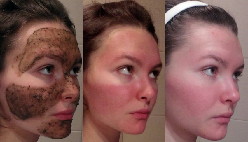 Бадяга от прыщей: состав, инструкция по применению, эффективность и рекомендации по выбору от косметологов и дерматологов (110 фото)