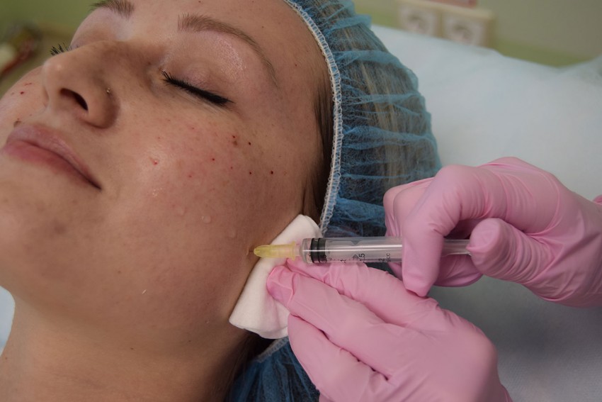 Биоревитализация: уход, противопоказания и показания к применению. Советы косметологов и результаты процедуры (145 фото и видео)