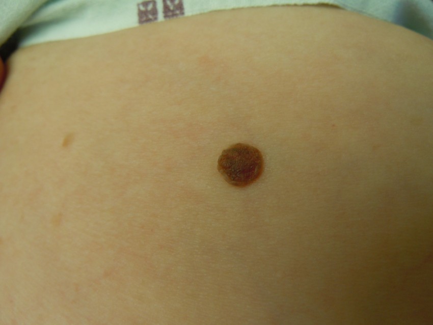 Болит родинка - к кому обращаться, причины болей и методы устранения болезненных ощущений и родинки (105 фото)