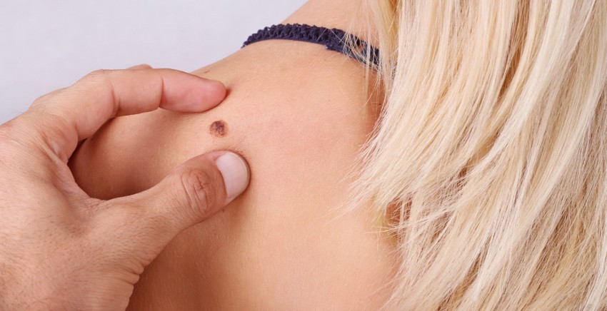 Болит родинка - к кому обращаться, причины болей и методы устранения болезненных ощущений и родинки (105 фото)