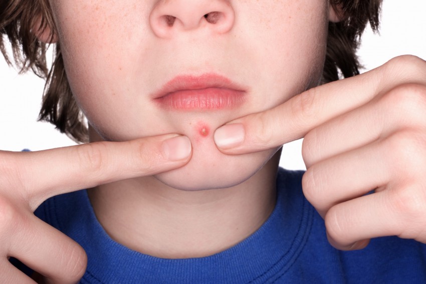 Большие прыщи - советы по выбору лекарства, особенности и принципы лечения как быстро и просто избавиться от прыщей (100 фото и видео)