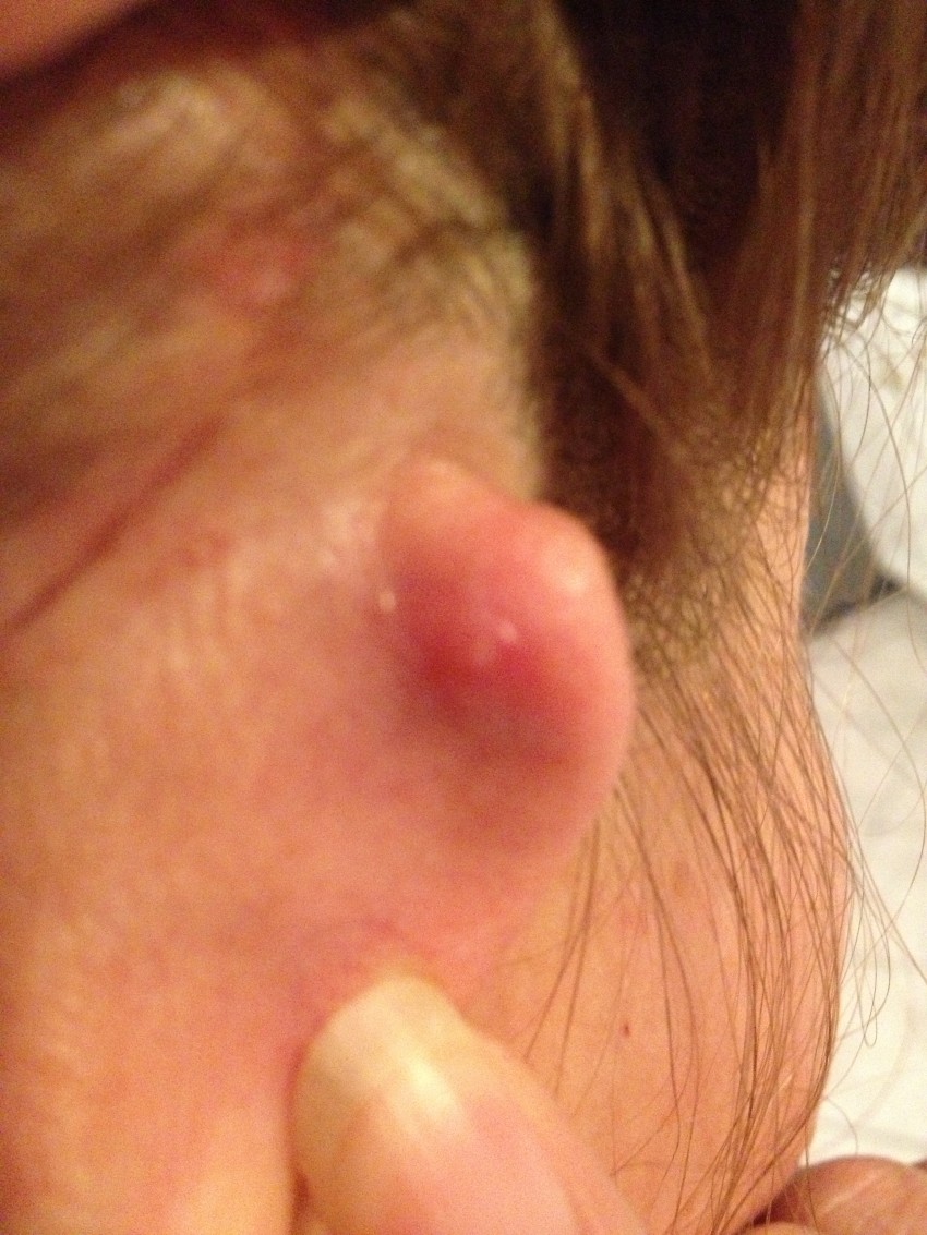 Большие прыщи - советы по выбору лекарства, особенности и принципы лечения как быстро и просто избавиться от прыщей (100 фото и видео)