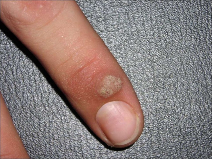 Бородавка на пальце: чем лечить, как удалить и к какому врачу следует обращаться с этой проблемой (115 фото)