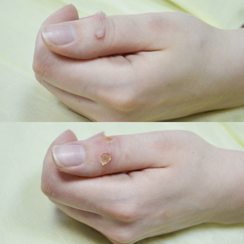 Бородавка на пальце: чем лечить, как удалить и к какому врачу следует обращаться с этой проблемой (115 фото)