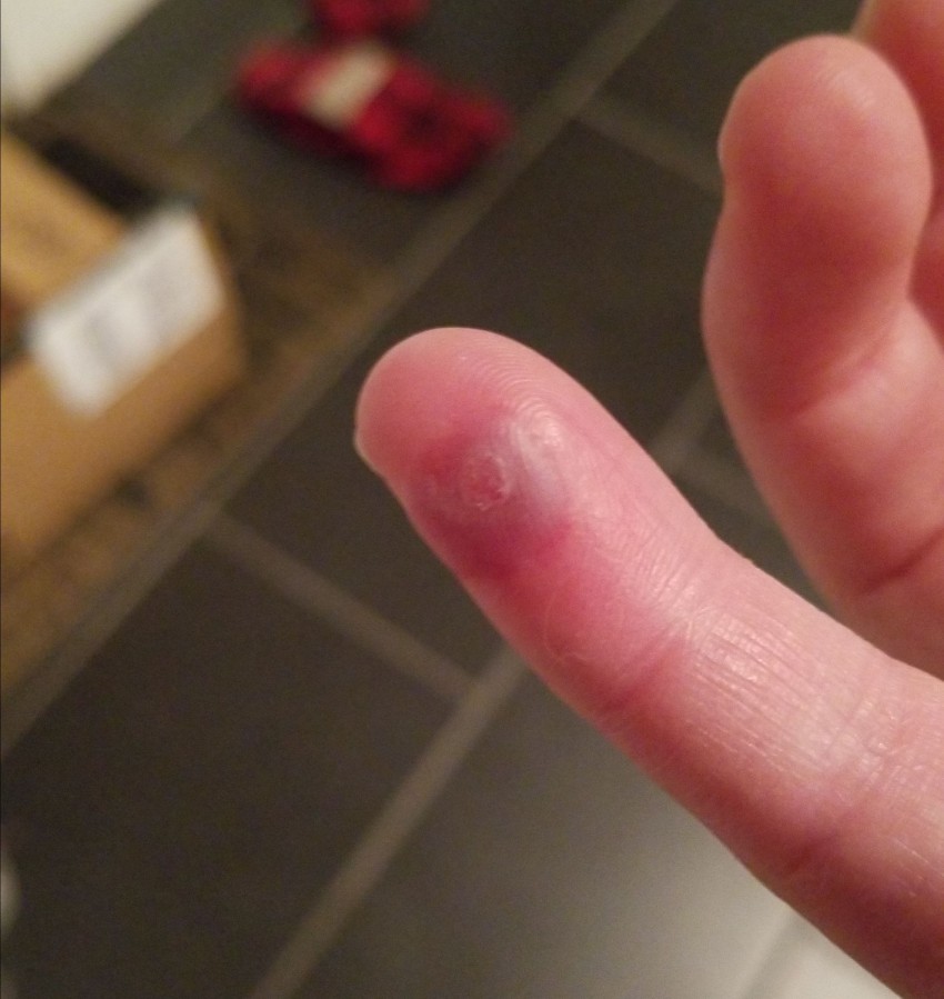 Бородавка на пальце: чем лечить, как удалить и к какому врачу следует обращаться с этой проблемой (115 фото)