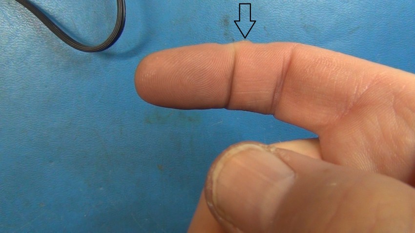 Бородавка на пальце: чем лечить, как удалить и к какому врачу следует обращаться с этой проблемой (115 фото)