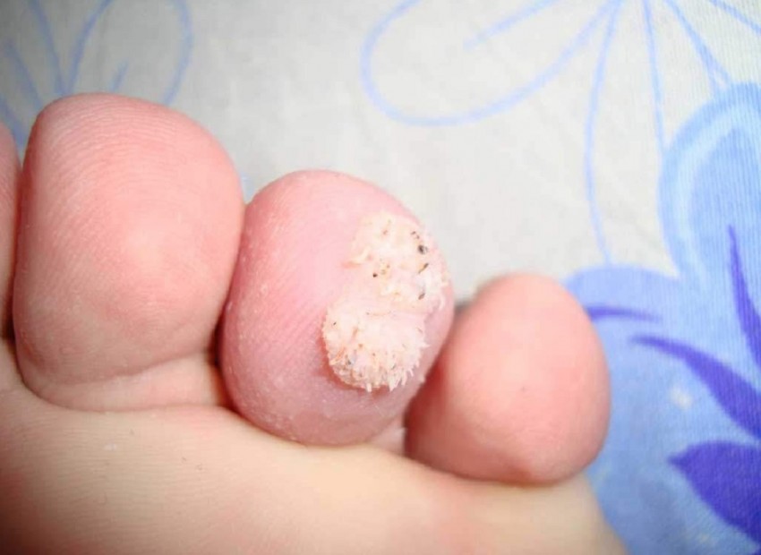 Бородавка на пальце ноги - причины появления, симптомы и удаление. 95 фото бородавок и видео лечения заболевания