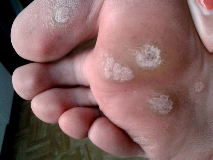 Бородавка на пальце ноги - причины появления, симптомы и удаление. 95 фото бородавок и видео лечения заболевания