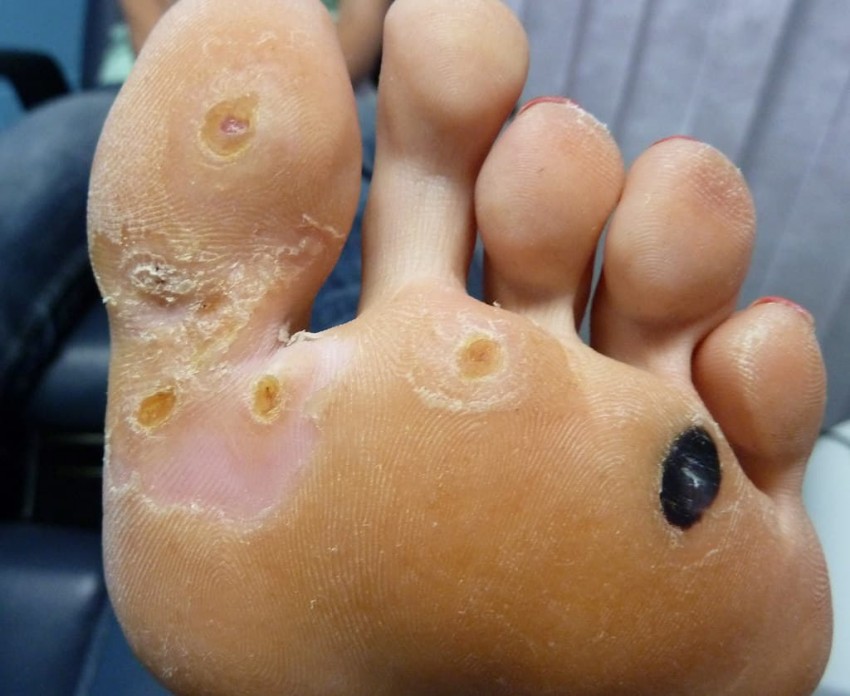 Бородавка на пальце ноги - причины появления, симптомы и удаление. 95 фото бородавок и видео лечения заболевания