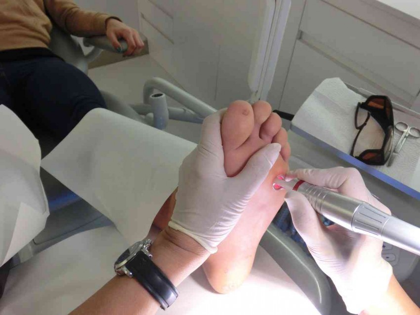 Бородавка на стопе - основные причины появления и методы избавления. Какой врач удаляет бородавки? (95 фото)