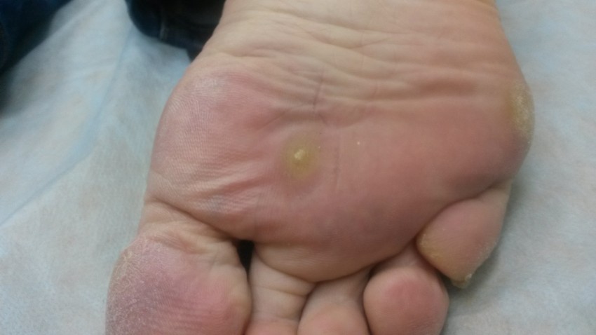 Бородавка на стопе - основные причины появления и методы избавления. Какой врач удаляет бородавки? (95 фото)