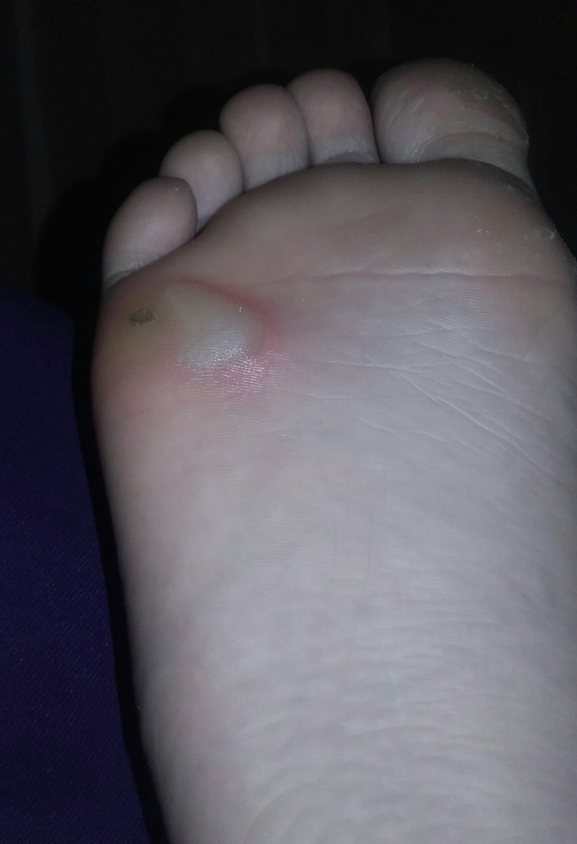 Бородавка на стопе - основные причины появления и методы избавления. Какой врач удаляет бородавки? (95 фото)