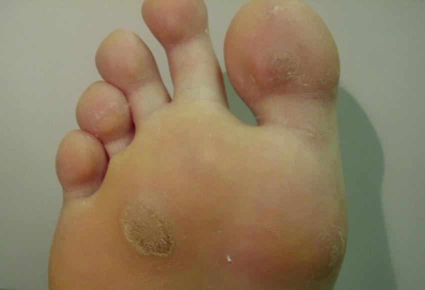 Бородавка на стопе - основные причины появления и методы избавления. Какой врач удаляет бородавки? (95 фото)